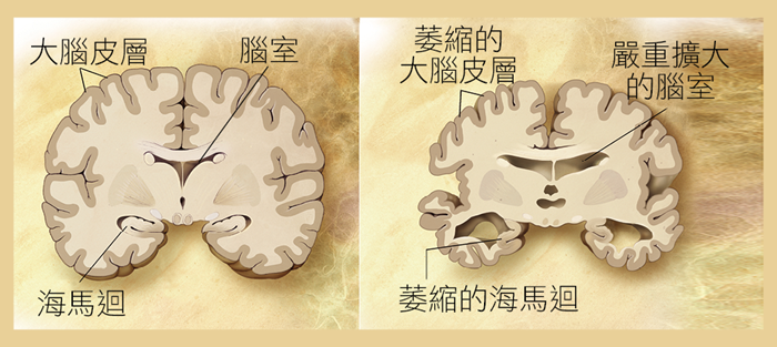 正常老人與老年癡呆症患者的大腦